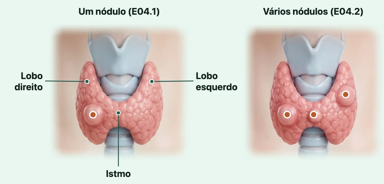 Dois quadros da mesma tireoide vista de frente, em forma de borboleta, com a laringe acima dela e o começo da traqueia abaixo. No quadro "Um nódulo (E04.1)", um nódulo liso e arredondado, marcado por um ponto, num dos lobos, e três rótulos: "Lobo direito", "Lobo esquerdo" e "Istmo", a ponte de tecido no meio que liga os dois lobos. No quadro "Vários nódulos (E04.2)", a mesma tireoide com três nódulos, cada um marcado por um ponto: um em cada lobo e um no istmo.