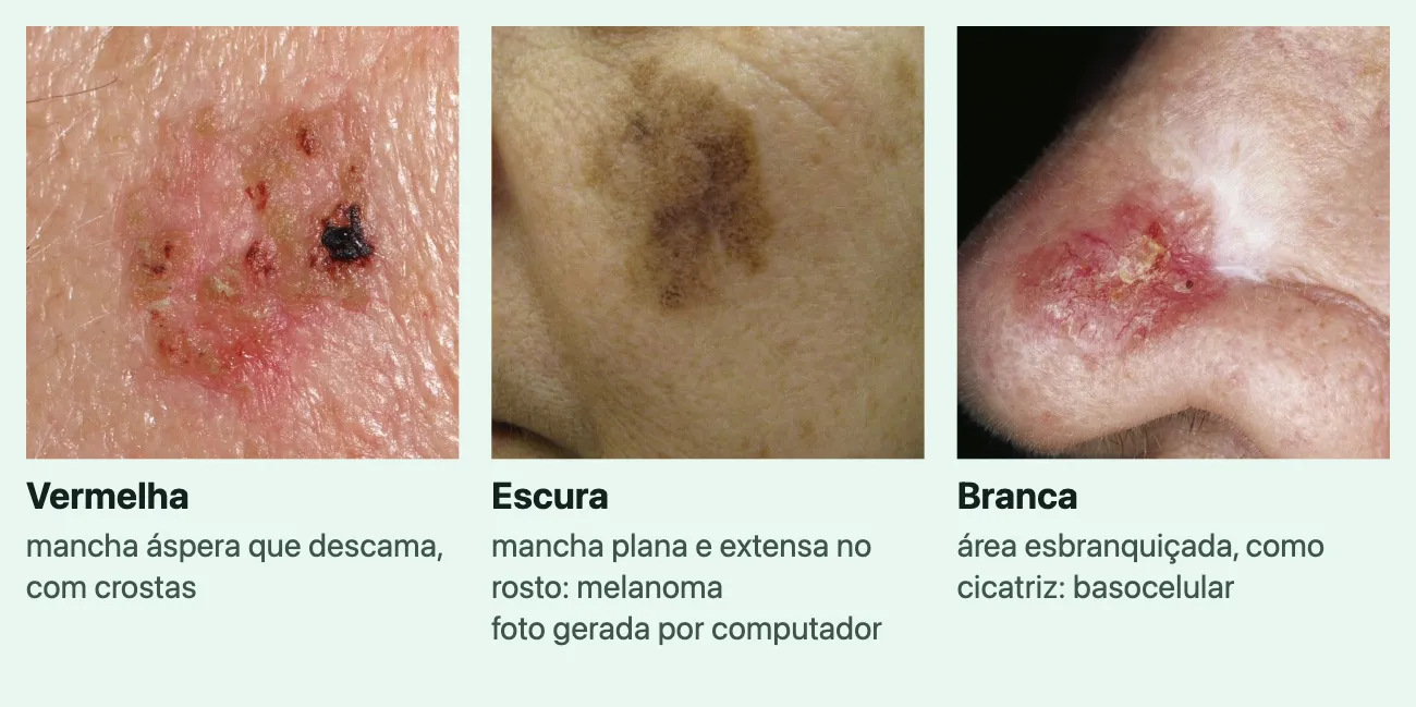 Três fotos de manchas, cada uma com a cor e uma linha. "Vermelha", "mancha áspera que descama, com crostas": uma mancha avermelhada que descama, com pontos de crosta escura, na pele clara. "Escura", "mancha plana e extensa no rosto: melanoma", marcada "foto gerada por computador": uma mancha marrom, plana, larga e de contorno irregular na bochecha de pele morena. "Branca", "área esbranquiçada, como cicatriz: basocelular": uma área esbranquiçada e lisa no nariz, com uma parte avermelhada e com crosta ao lado.