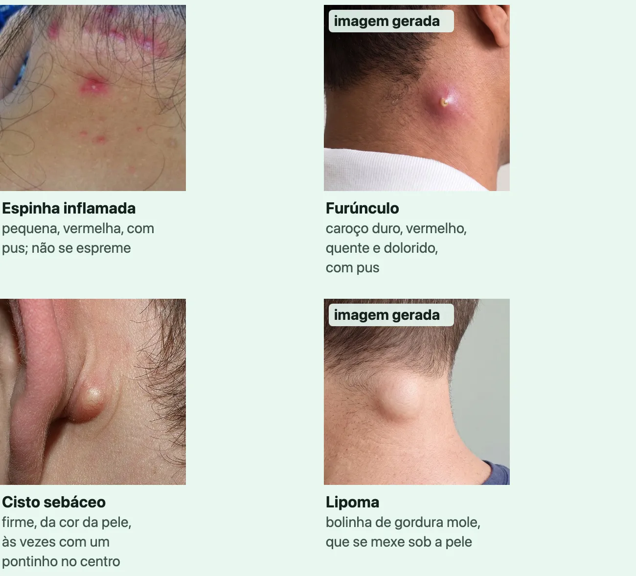 Quatro fotos de perto da pele do pescoço, sem os olhos: espinhas vermelhas na nuca, a maior com uma cabecinha de pus; um furúnculo, um caroço vermelho e inchado com um ponto amarelado; um cisto sebáceo, uma bolinha firme da cor da pele logo atrás da orelha; e um lipoma, um volume liso e arredondado sob a pele da nuca.
