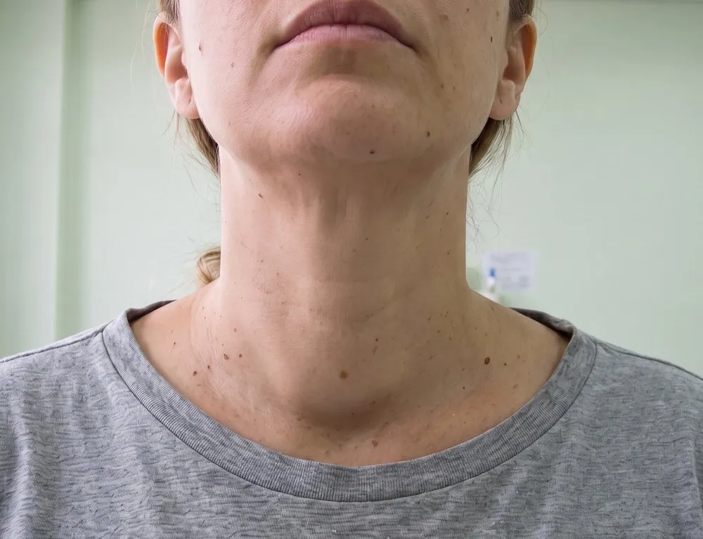 O mesmo pescoço com um volume liso e largo na parte de baixo da frente, logo acima da base, que arredonda a linha do pescoço dos dois lados da traqueia.