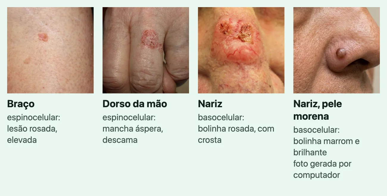 Quatro fotos de câncer de pele em lugares do corpo, cada uma com o lugar e uma linha. "Braço", "espinocelular: lesão rosada, elevada": uma lesão pequena, rosada e elevada na pele clara do braço. "Dorso da mão", "espinocelular: mancha áspera, descama": uma mancha avermelhada que descama sobre a junta de um dedo. "Nariz", "basocelular: bolinha rosada, com crosta": uma lesão rosada e elevada, com crostas amareladas, no nariz. "Nariz, pele morena", "basocelular: bolinha marrom e brilhante", marcada "foto gerada por computador": uma bolinha marrom e brilhante na asa do nariz de pele morena.