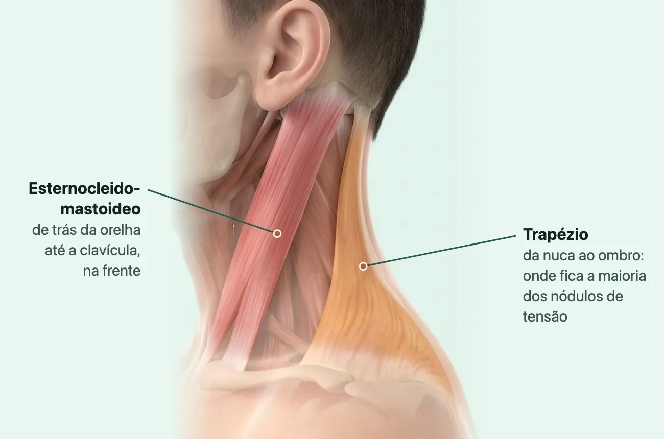 Desenho do lado da cabeça, do pescoço e do ombro, de perfil, com a pele transparente: em vermelho-rosado, o músculo esternocleidomastoideo, que desce de trás da orelha até a frente do pescoço junto à clavícula; em âmbar, o trapézio, que cobre a nuca e desce até o ombro.
