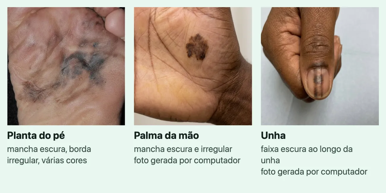 Três fotos de melanoma em pele negra ou parda, cada uma com o lugar e uma linha. "Planta do pé", "mancha escura, borda irregular, várias cores": uma mancha grande, acinzentada e marrom, de borda irregular, na sola do pé. "Palma da mão", "mancha escura e irregular", marcada "foto gerada por computador": uma mancha marrom de contorno recortado no meio da palma de uma mão de pele negra. "Unha", "faixa escura ao longo da unha", marcada "foto gerada por computador": uma faixa escura que corre da base à ponta da unha do polegar, numa mão de pele negra.