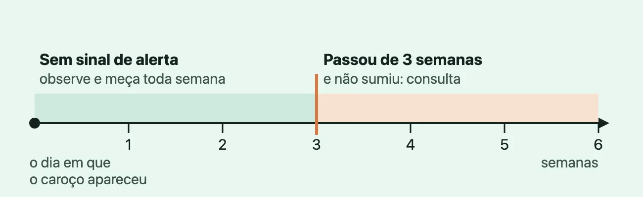 Linha do tempo de 0 a 6 semanas a partir do dia em que o caroço apareceu: até 3 semanas, uma faixa verde, "sem sinal de alerta: observe e meça toda semana"; em 3 semanas, uma linha laranja, "passou de 3 semanas e não sumiu: consulta".