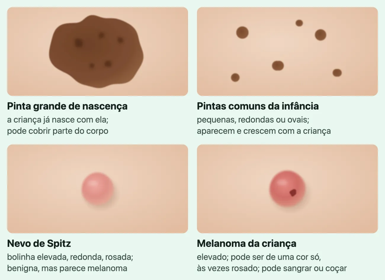 Desenho de quatro retalhos de pele vistos de perto, cada um com o nome e uma linha. "Pinta grande de nascença", "a criança já nasce com ela; pode cobrir parte do corpo": uma mancha marrom grande, que ocupa quase todo o retalho, com pontos mais escuros. "Pintas comuns da infância", "pequenas, redondas ou ovais; aparecem e crescem com a criança": seis pintas pequenas e marrons, espalhadas. "Nevo de Spitz", "bolinha elevada, redonda, rosada; benigna, mas parece melanoma": uma bolinha rosada e redonda, com sombra de elevação. "Melanoma da criança", "elevado; pode ser de uma cor só, às vezes rosado; pode sangrar ou coçar": uma bolinha parecida, um pouco mais avermelhada, com um ponto de crosta escura.