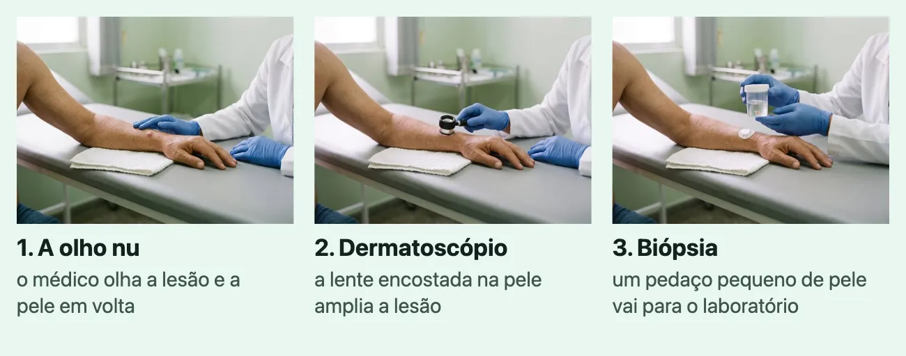 Três fotos da mesma cena, numeradas em ordem: um antebraço apoiado numa maca de consultório e as mãos de um médico com luvas azuis. "1. A olho nu", "o médico olha a lesão e a pele em volta": as mãos do médico ao lado da lesão do antebraço. "2. Dermatoscópio", "a lente encostada na pele amplia a lesão": o médico encosta o dermatoscópio na pele, sobre a lesão. "3. Biópsia", "um pedaço pequeno de pele vai para o laboratório": um curativo pequeno no lugar da lesão, e o médico segura um frasco com líquido.