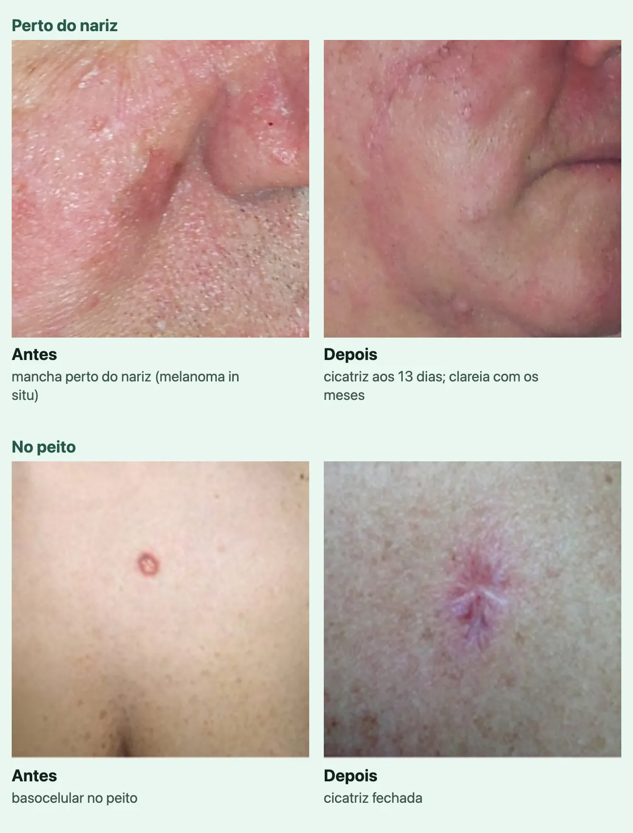 Dois pares de fotos, antes e depois da cirurgia, cada foto com uma linha. "Perto do nariz": "Antes", "mancha perto do nariz (melanoma in situ)", uma mancha avermelhada na bochecha, junto ao nariz; "Depois", "cicatriz aos 13 dias; clareia com os meses", a mesma região com a linha fina e rosada da cicatriz, descendo do lado do nariz até perto do queixo. "No peito": "Antes", "basocelular no peito", uma lesão pequena, redonda e rosada na pele clara do peito; "Depois", "cicatriz fechada", uma cicatriz rosada, curta e fechada.