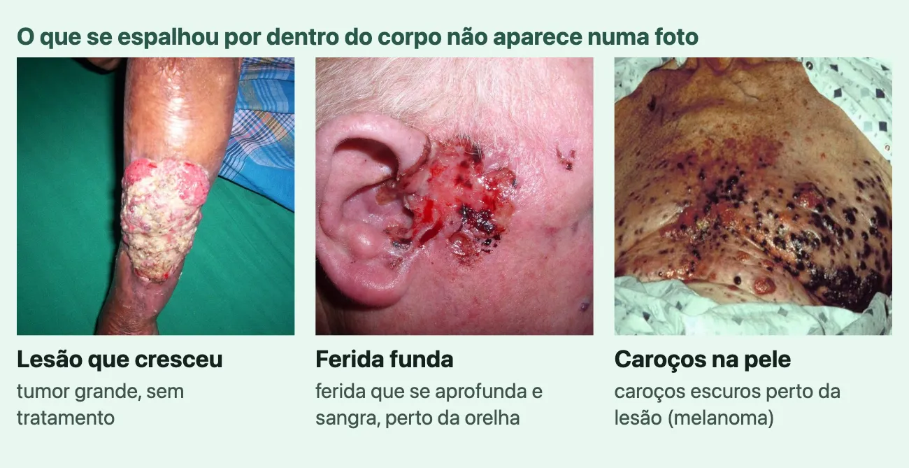 Três fotos de câncer de pele avançado, sob o título "O que se espalhou por dentro do corpo não aparece numa foto", cada uma com o nome e uma linha. "Lesão que cresceu", "tumor grande, sem tratamento": um tumor grande, elevado e irregular, rosado e amarelado, que cobre parte de um membro. "Ferida funda", "ferida que se aprofunda e sangra, perto da orelha": uma ferida larga e vermelha, com sangue e crostas escuras, na pele à frente da orelha. "Caroços na pele", "caroços escuros perto da lesão (melanoma)": muitos caroços escuros, de tamanhos diferentes, espalhados pela pele do peito.