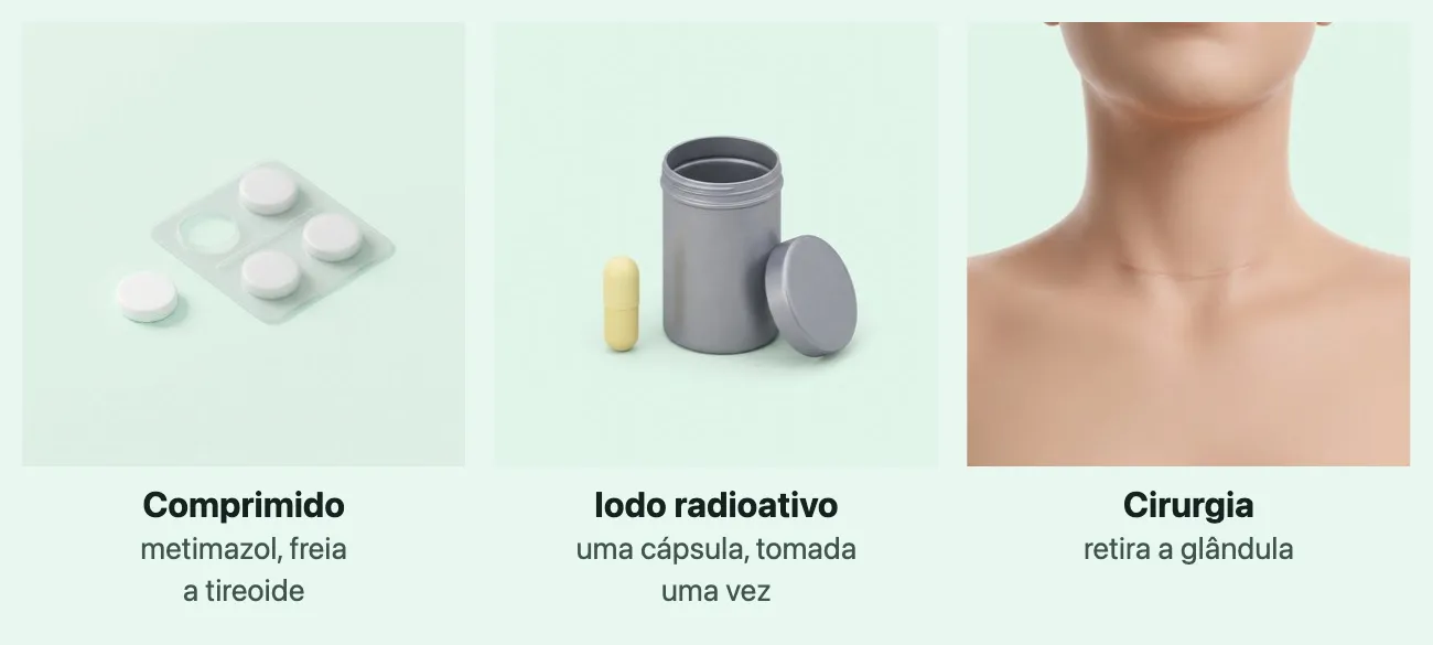 Três quadros. No primeiro, Comprimido, metimazol, freia a tireoide: uma cartela de comprimidos brancos com um comprimido solto ao lado. No segundo, Iodo radioativo, uma cápsula, tomada uma vez: uma cápsula amarela ao lado de um pote de metal cinza com a tampa aberta. No terceiro, Cirurgia, retira a glândula: a frente do pescoço e o alto do peito de uma pessoa, com uma linha fina e clara na base do pescoço.
