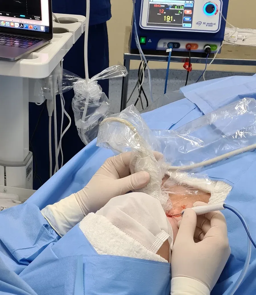 Dr. Stéfano Fiúza realizando radioablação de nódulo da tireoide